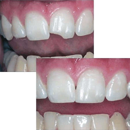 Chipped tooth repair