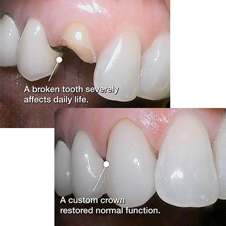 Custom Dental Crown