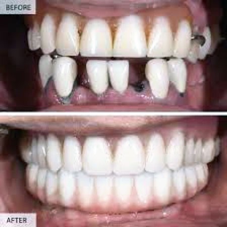 Dental Implants